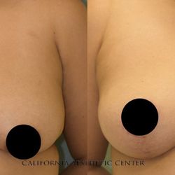 Steve T. Vu MD, FACS - Mastopexy (Breast Lift) 4 months post-op.