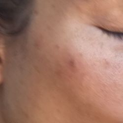Amira Acne Solutions - It was hard to find a Before photo but you can tell I had pimples everywhere and acne spots.