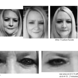 Pure Skin + Body - Carbon facial with the a light microdermabrasion which is followed by application of a special cream containing volcanic ash...
