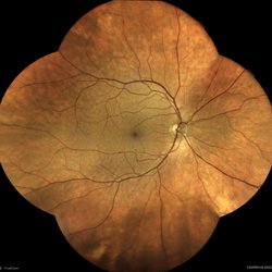 Retinal photos of the right eye