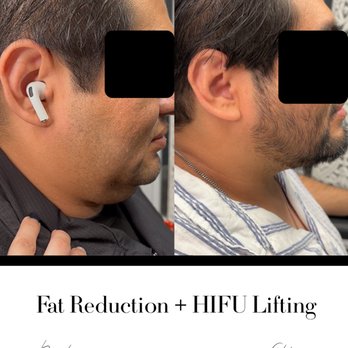 Soulmate Medspa - Dramatic jawline transformation! Our secret fat reduction + HIFU laser lifting combo slims double chins & tightens sagging skin. - Weight Loss Centers Near Me - Anaheim, California Soulmate Medspa - Dramatic jawline transformation! Our secret fat reduction + HIFU laser lifting combo slims double chins & tightens sagging skin. - Weight Loss Centers Near Me - Anaheim, California