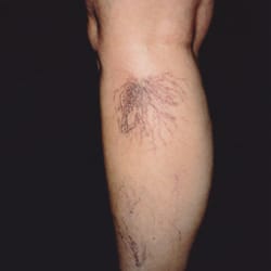 Schulman Vein and Laser Center - spider veins before treatment