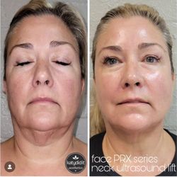 katydid it aesthetics - PRX & Laser Lift