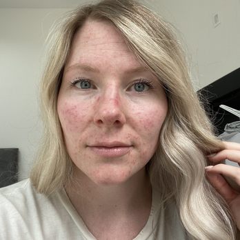 Eden Skin - Beginning of skin issue a few years before seeing Brittany. I was still dealing with residuals of this when I started with her. - Skin Care Near Me - Solana Beach, California Eden Skin - Beginning of skin issue a few years before seeing Brittany. I was still dealing with residuals of this when I started with her. - Skin Care Near Me - Solana Beach, California
