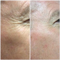 Phoenix Tattoo Removal and Skin Revitalization - Alma™ non-ablative ClearLift resurfacing treatment Improve skin texture' Smooth fine lines Decrease melasma