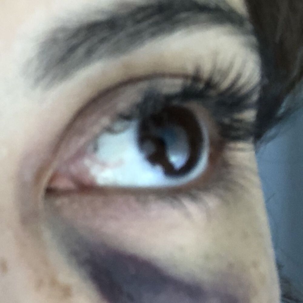 Sovous - 1 Day after tear through - Cosmetic Surgeons Near Me - New York, New York Sovous - 1 Day after tear through - Cosmetic Surgeons Near Me - New York, New York