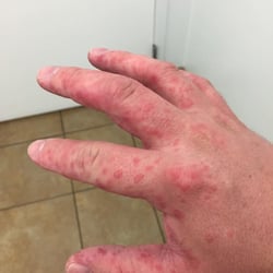 Access Medical Center Urgent Care, Moore - They knew he was allergic to this stuff but gave it to him anyway. Pharmacist said he's lucky to be alive. Never even got an apology.