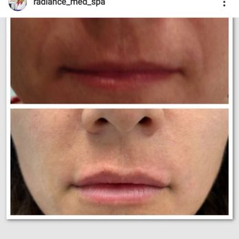 Radiance Medspa - Natural yet beautiful created by injecting Restylane Refyne! - Medical Spas Near Me - Weston, Florida Radiance Medspa - Natural yet beautiful created by injecting Restylane Refyne! - Medical Spas Near Me - Weston, Florida