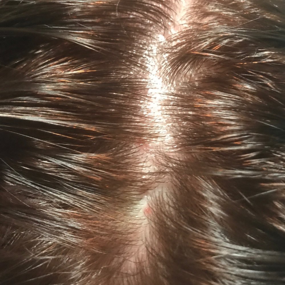 Blisters all over my scalp that scabbed over. Blisters all over my scalp that scabbed over.