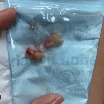 Brennan L Hughes, DMD - Two wisdom teeth that were extracted. - Oral Surgeons Near Me - Pico Rivera, California Brennan L Hughes, DMD - Two wisdom teeth that were extracted. - Oral Surgeons Near Me - Pico Rivera, California