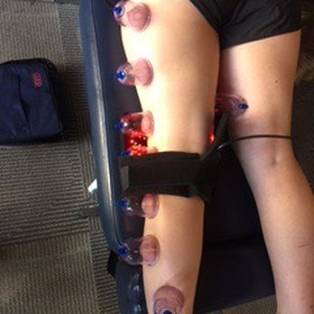 Bloch - Cupping and getting better everyday - Chiropractors Near Me - Long Beach, California Bloch - Cupping and getting better everyday - Chiropractors Near Me - Long Beach, California