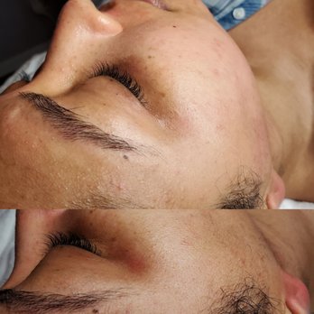 Skin Identity - Before & After ::. Signature Detox with Dermaplane Facial - Skin Care Near Me - Washington, DC, District of Columbia Skin Identity - Before & After ::. Signature Detox with Dermaplane Facial - Skin Care Near Me - Washington, DC, District of Columbia
