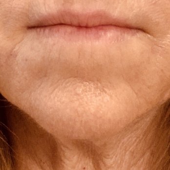 Ageless Energetics - After - Medical Spas Near Me - Boca Raton, Florida Ageless Energetics - After - Medical Spas Near Me - Boca Raton, Florida