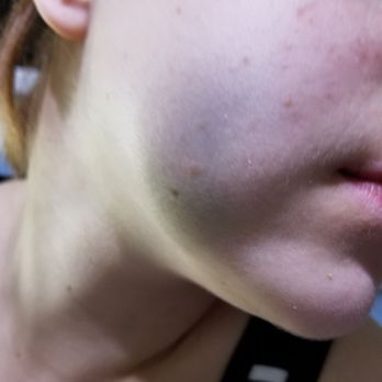 Absolute Dental - Nellis - Gf got a bruise after going to this place. Getting her fillings done. Now she got a big bruise and her face hurts Stay away from this place - General Dentistry Near Me - Las Vegas, Nevada
