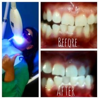 Rapid Smile - Richardson - I LOVE my results - Teeth Whitening Near Me - Richardson, Texas