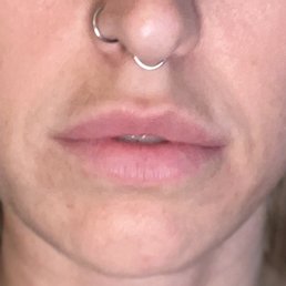 Lip filler - full syringe (fully healed from any injection site bruising) Lip filler - full syringe (fully healed from any injection site bruising)