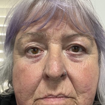 The Eye Spot - patient wearing corneal scleral shell - Prosthetics Near Me - Greensboro, North Carolina The Eye Spot - patient wearing corneal scleral shell - Prosthetics Near Me - Greensboro, North Carolina