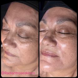 HydraFacial