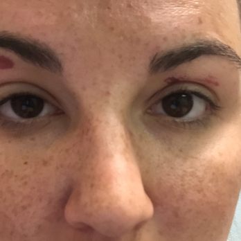 21 Nails - Burnt & swollen - Nail Salons Near Me - Bradenton, Florida