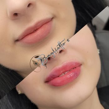 Baglietto's MedSpa - Lipfillers - Medical Spas Near Me - Miami, Florida Baglietto's MedSpa - Lipfillers - Medical Spas Near Me - Miami, Florida