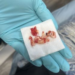 Well Beyond Dental - Two widsom teeth that were extracted.