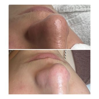 Total vanity esthetics - Teen facials - Estheticians Near Me Total vanity esthetics - Teen facials - Estheticians Near Me