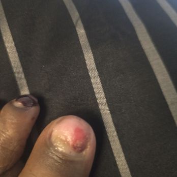Matrix Nails - My toe with out a nail - Nail Salons Near Me - Jacksonville, Florida