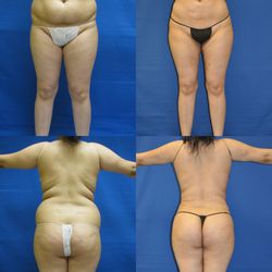 Ciao Bella - Liposuction full torso