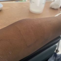 Research Medical Center - Hematoma on arm
