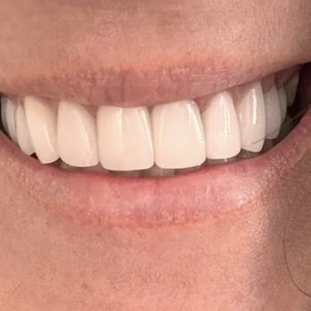 The Tooth Co - BEFORE Bulky, oversized, chicolata veneers. They were also lobsided - Cosmetic Dentists Near Me - Irvine, California The Tooth Co - BEFORE Bulky, oversized, chicolata veneers. They were also lobsided - Cosmetic Dentists Near Me - Irvine, California