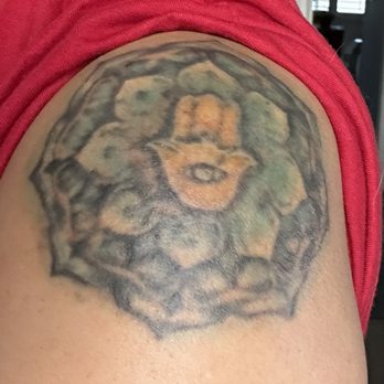 Removery Tattoo Removal & Fading - 6dys after 1session. Still healing - Tattoo Removal Near Me - Henderson, Nevada Removery Tattoo Removal & Fading - 6dys after 1session. Still healing - Tattoo Removal Near Me - Henderson, Nevada