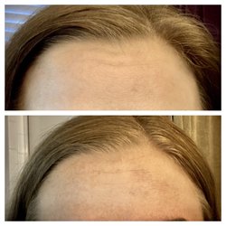 Nuebella - My forehead before and after showing the severe hyperpigmentation.