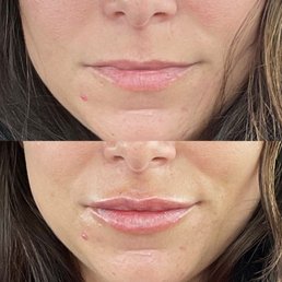 Before and after one treatment of filler on top lip Before and after one treatment of filler on top lip