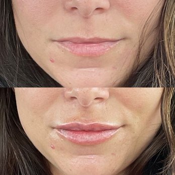 Arabella Boutique Med Spa - Before and after one treatment of filler on top lip - Medical Spas Near Me - Oakbrook Terrace, Illinois Arabella Boutique Med Spa - Before and after one treatment of filler on top lip - Medical Spas Near Me - Oakbrook Terrace, Illinois