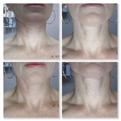 Luxe Beauty Now - Pelleve skin tightening