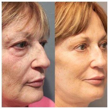 Restore Plastic Surgery - Complete Facial Rejuvenation - Cosmetic Surgeons Near Me - Pensacola, Florida