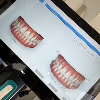 Lasting Impressions Dental Spa - Invisalign outcome simulator - Cosmetic Dentists Near Me - Encino, California Lasting Impressions Dental Spa - Invisalign outcome simulator - Cosmetic Dentists Near Me - Encino, California