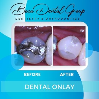 Boca Dental Group - Dental onlay - General Dentistry Near Me - Boca Raton, Florida
