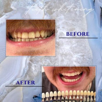 SkyeBright Smile - BRiGHT service
Before: Shade 28
After: Shade 10 - Teeth Whitening Near Me - Martinsville, Virginia SkyeBright Smile - BRiGHT service
Before: Shade 28
After: Shade 10 - Teeth Whitening Near Me - Martinsville, Virginia