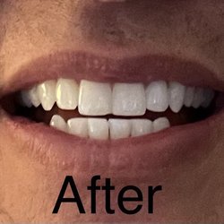 Thornton Park Dental Arts - After procedure