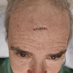 Dermatology Specialists - Basal Cell Cacinoma (BCC) completely removed using MOHS surgery