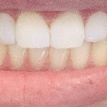 Ng Linda L DDS - After: crooked front tooth to "fill" in my gaps BUT THEY CHIPPED OFF IN ONE AND A HALF WEEKS. $600 down the drain. - Oral Surgeons Near Me - Arcadia, California Ng Linda L DDS - After: crooked front tooth to "fill" in my gaps BUT THEY CHIPPED OFF IN ONE AND A HALF WEEKS. $600 down the drain. - Oral Surgeons Near Me - Arcadia, California