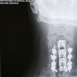 Good Samaritan Medical Center - Outside screws are the most recent. He also did a Laminectomy, Facetectomy, and Foraminotomy.