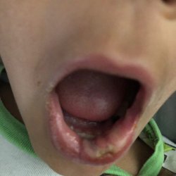 Absolute Dental - Nellis - This was the result of a dirty instrument and the inexperience dentist at Absolute Dental.