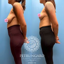 Petrungaro Plastic Surgery - Breast reduction and lift.