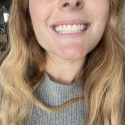 JP Teeth Whitening Service - After (better lighting)