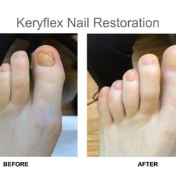 Alexandria Family Podiatry - One of our patients came in with an incomplete nail, and walked out with a new nail and ready for the beach!