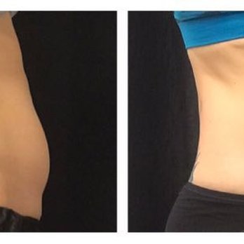 Advanced Skin and Body Solutions - Coolsculpt results. - Medical Spas Near Me - Bellevue, Washington