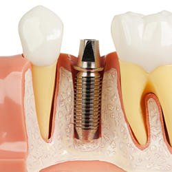 Premier Oral Surgery & Implantology Center