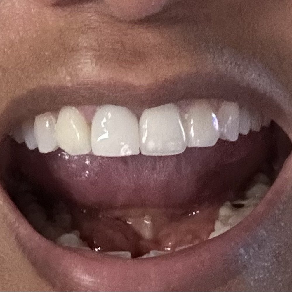 Dr. Ignacio de la Vega - AFTER - General Dentistry Near Me - Tijuana, BCN